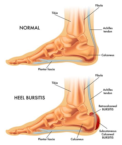 Bursitis Causes Treatment My FootDr