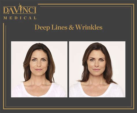 Da Vinci Clinic Deep Lines And Wrinkles Using Dermal Fillers Injection