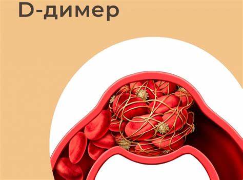 Повышен д димер диета Тест на Д-димер Тест на Д-димер Повышен д димер диета