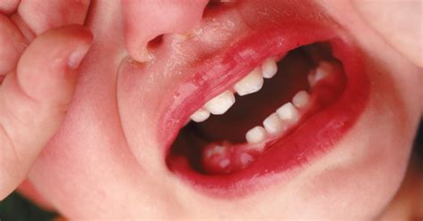 Emily lawrenson & bronwen griffiths. Swollen Gums in an Infant | LIVESTRONG.COM