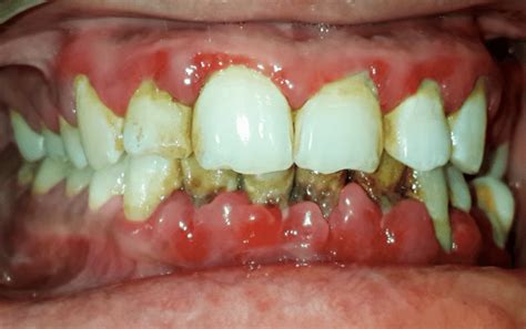 Intraoral Examination Showing Bright Red Colored Gingival With Bleeding