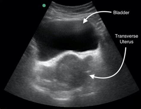 Transverse Transabdominal Us Image Shows A Uterus My Xxx Hot Girl