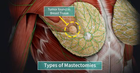 Types Of Mastectomy Complete Anatomy