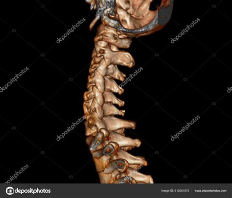 Scan Spine Cervical Spine Rendering Diagnosis Fracture Cervical Spine