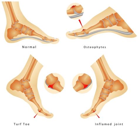 Turf toe is essentially a sprain or hyperextension of the toe. Turf toe - Physiopedia