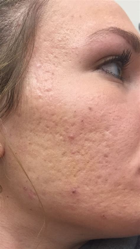 How Severe Are My Acne Scars Scar Treatments Community