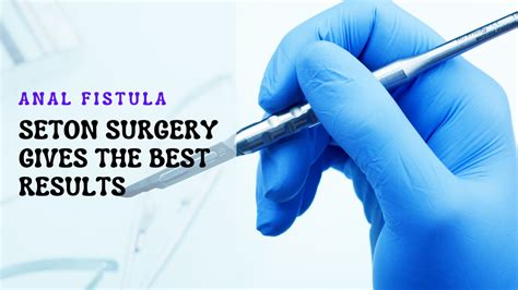 Anal Fistula The Best Option Is Seton Surgery Dr Rajeev Kapoor