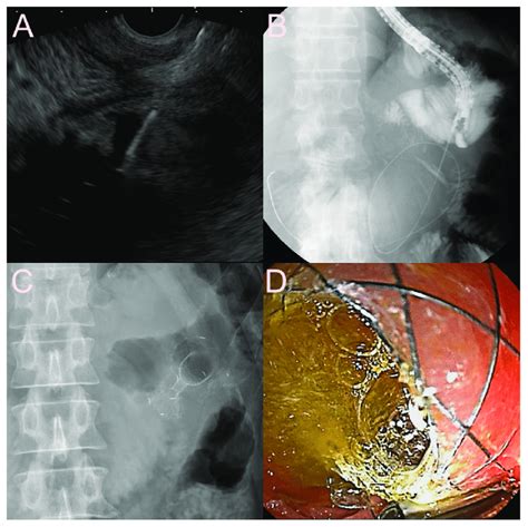 Ultrasound Guided Jejunojejunostomy Using The Dedicated Bi Flanged