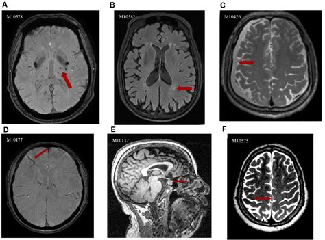 Frontiers Incidental Brain Magnetic Resonance Imaging Findings And