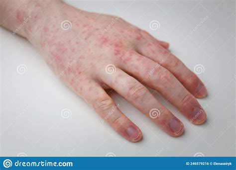 Allergy Red Itchy Rash On Male Hand On White Table Dermatological