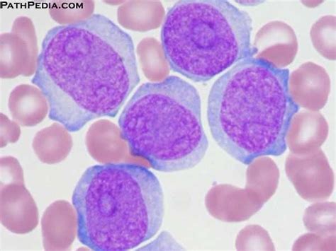 Acute Monoblastic Leukemia Aml M5a Monoblasts Are Typically Larger