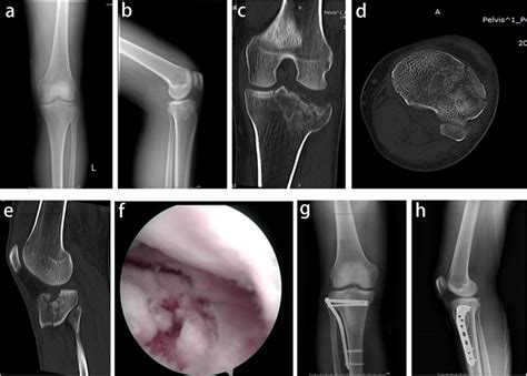 A Case Of Schatzker Type Ii Tibial Plateau Fractures Male 47 Years