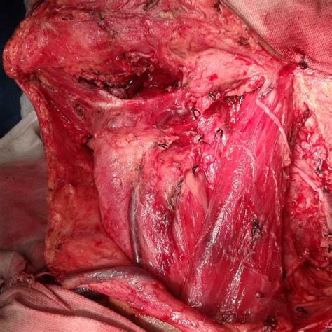 Neck Dissection Showing Left Level Ii Lymph Node Adherent To Ijv
