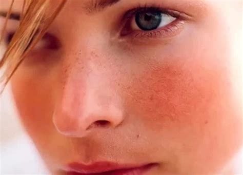 Rosacea: cause, effetti, diagnosi e visione psicosomatica ...