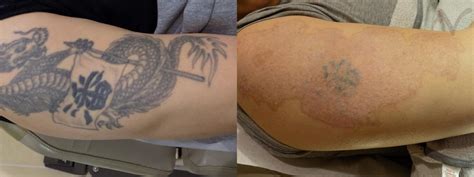 Picosure Laser Tattoo Removal Before And After Pictures Case 322 Los Angeles Ca Armen