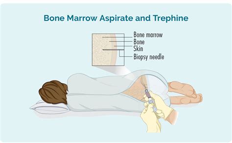 Bone Marrow Biopsy Lymphoma Australia