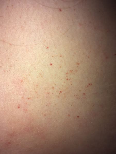 What Are These Little Red Dots On My Chest Design Talk