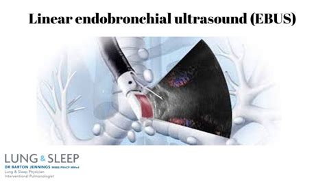 Linear Endobronchial Ultrasound Ebus Bronchoscopy Demonstration