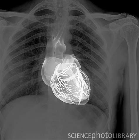 The Heart X Ray Centre Has Been Aligned With A Chest X Ray To Show