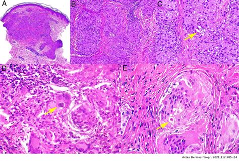 Granulomas In Dermatopathology Principal Diagnoses — Part 2 Actas