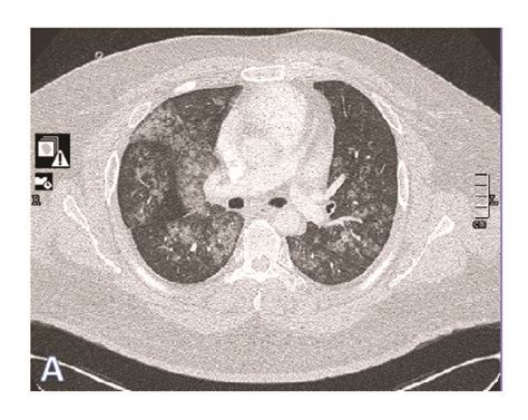 A Chest Ct Scan On Admission With Diffuse Ground Glass Opacity And