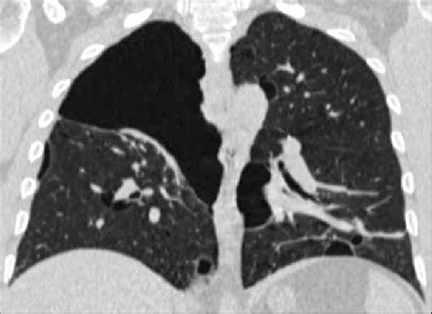 Maybe you would like to learn more about one of these? Coronal reformatted CT scan of Patient 1 demonstrates a ...