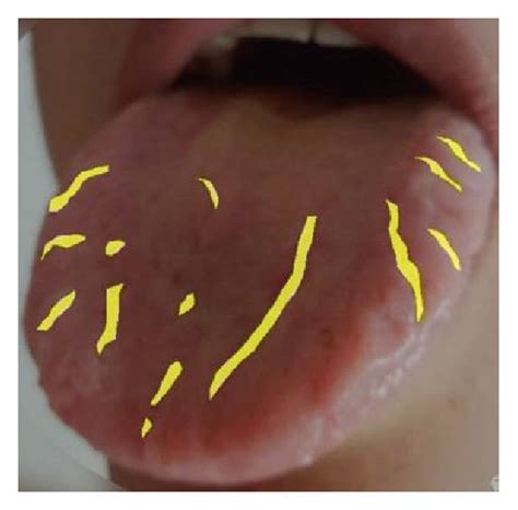 Six Cases Of Fissured Tongue Images And Data Preprocessing Results A