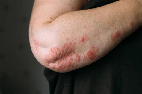 Psoriasis On Elbow Closeup Photo Of Dry Flaky Skin With Red Spots