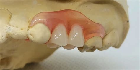 Partial Dentures One Tooth
