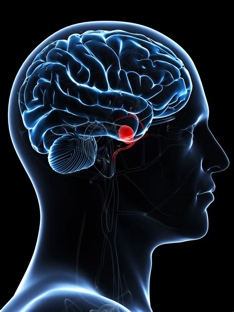 Brain Aneurysms Symptoms Causes Diagnosis And Treatment
