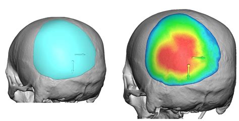 Blog Archivecase Study Custom Skull Implant For Occipital