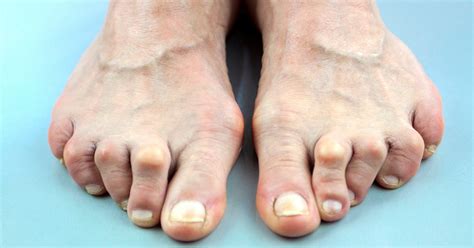 Treating Rheumatoid Arthritis Of The Foot And Ankle