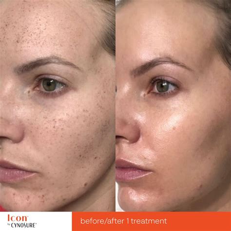 Before And After Cynosure Icon Technology Ipl Photofacial