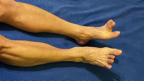 Acupuncture was found to improve plantar heel pain through various pathways. Plantar Fasciitis Relief with Simple,Convenient and ...