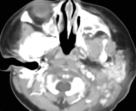 Ct Of The Pharynx Showed Diffuse Swelling And Prominent Contrast