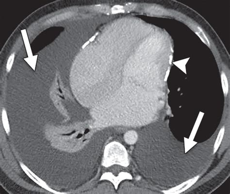 Nutmeg Liver Ultrasound