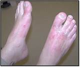 Shoe Contact Dermatitis Treatment