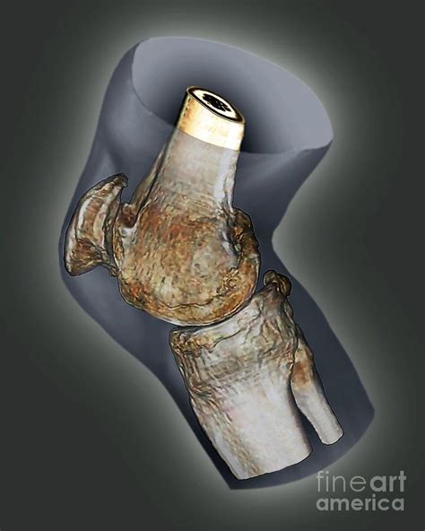 Arthritis Of The Knee 3d Ct Scan Photograph By Zephyr Fine Art America