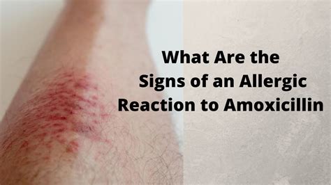 What Are The Signs Of An Allergic Reaction To Amoxicillin Youtube