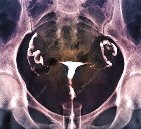 Healthy Female Reproductive System X Ray Stock Image C0488818
