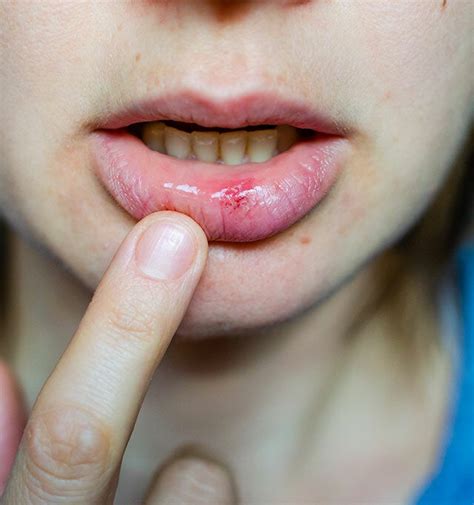 consejos para tratar heridas en la boca causadas por agua con sal blog dental irriak