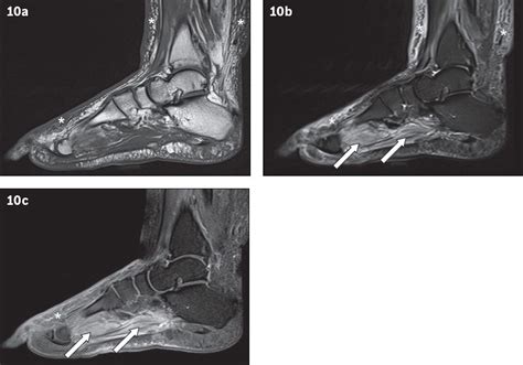 Plantar Foot Muscles Mri Foot Ankle And Calf Musculoskeletal Key