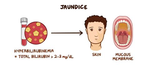Approach To Jaundice Conjugated Hyperbilirubinemia Clinical Sciences