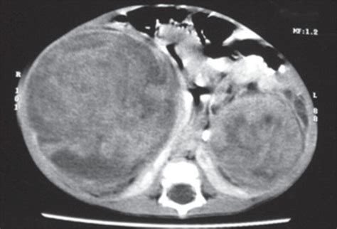 Contrast Enhanced Axial Computed Tomography Scan Showing Bilateral