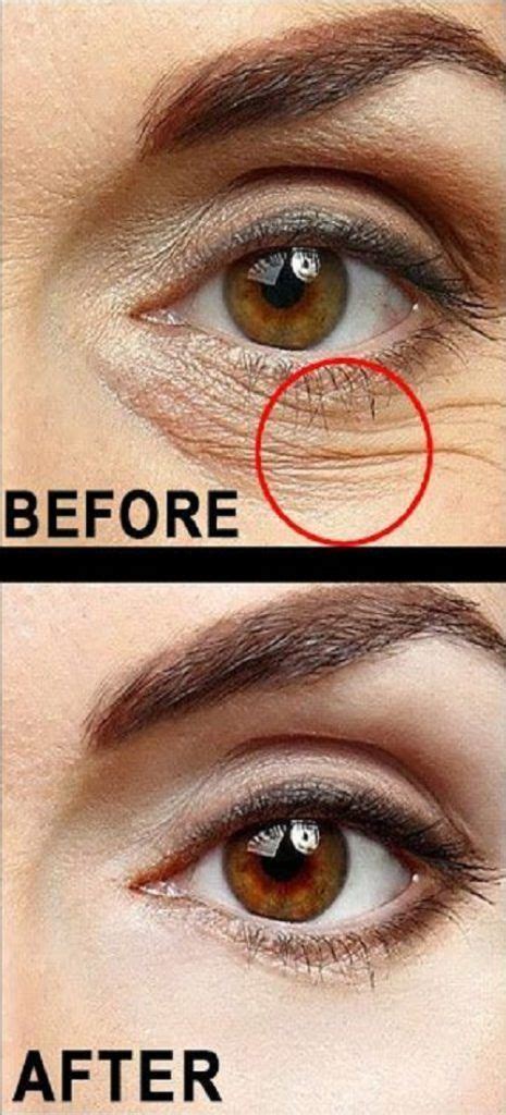 How To Remove Eye Wrinkles Now Remove Eye Wrinkles Under Eye