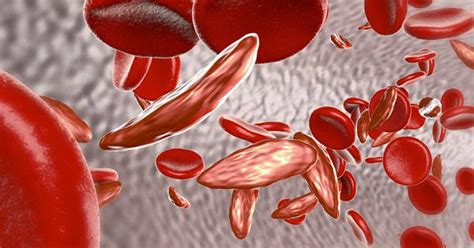 6 Signos Para Reconocer Anemia De Células Falciformes
