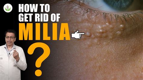 How To Get Rid Of Milia Milia Cure Treatment In Delhi 2022 Care