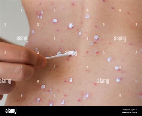 Herpes Zoster Rash Blisters Hi Res Stock Photography And Images Alamy