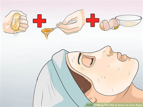 Learn how to treat & get rid of it. 4 Ways to Get Rid of Acne on Your Nose - wikiHow