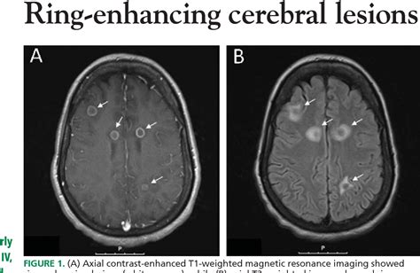Figure 1 From Ring Enhancing Cerebral Lesions Semantic Scholar